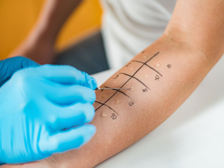 Allergologo esegue un test cutaneo per la diagnosi delle allergie stagionali.