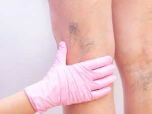 Chirurgo vascolare mentre esamina le vene varicose di un paziente.